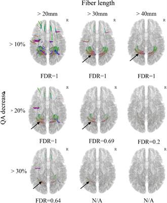 Differential Tractography and Correlation Tractography Findings on Patients With Mild Traumatic Brain Injury: A Pilot Study